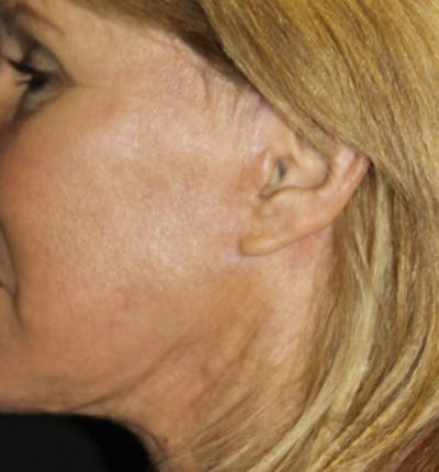 Facelift Scar Before & After Gallery - Patient 133024002 - Image 2