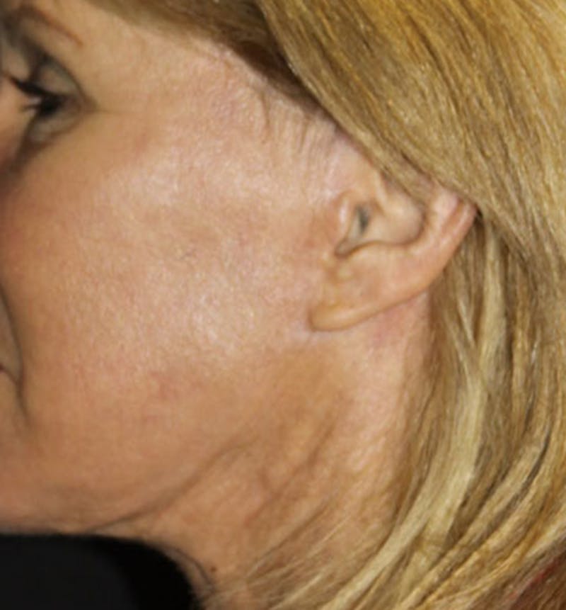 Facelift Scar Before & After Gallery - Patient 133024002 - Image 2