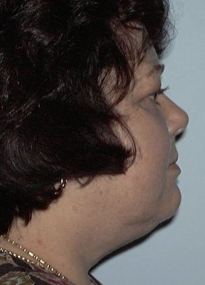 Neck Liposuction Before & After Gallery - Patient 133024003 - Image 2