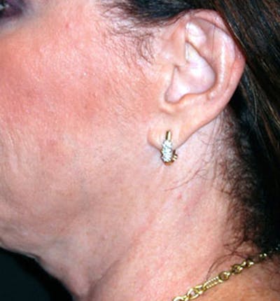 Facelift Scar Before & After Gallery - Patient 133024006 - Image 1