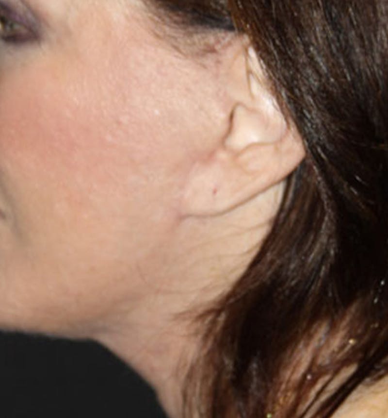 Facelift Scar Before & After Gallery - Patient 133024006 - Image 2
