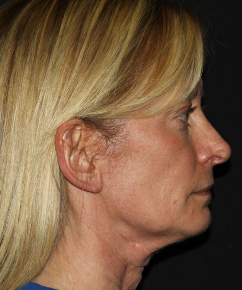 Facelift & Necklift Before & After Gallery - Patient 133024018 - Image 1