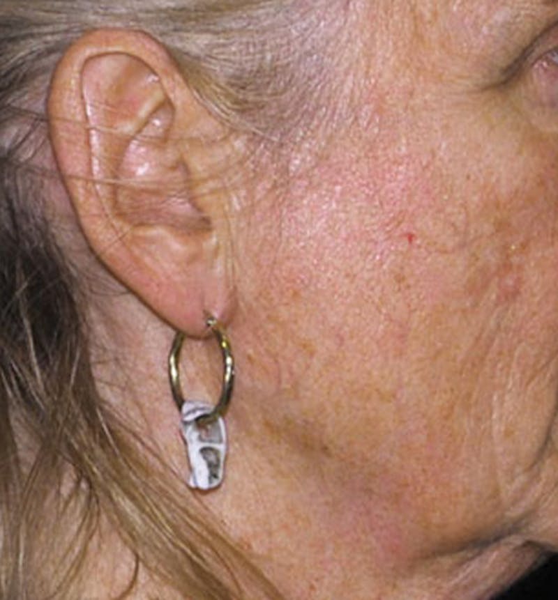 Facelift Scar Before & After Gallery - Patient 133024010 - Image 1