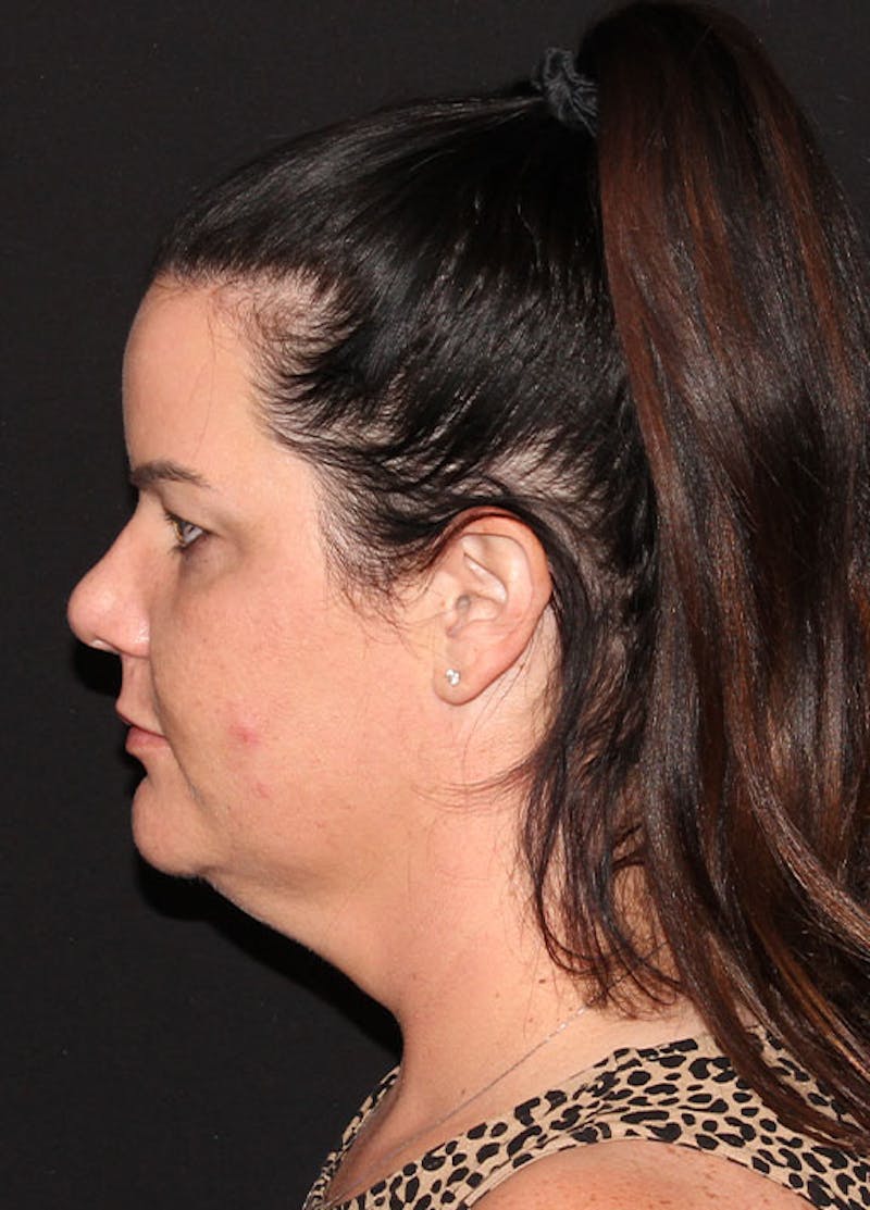 Neck Liposuction Before & After Gallery - Patient 133024013 - Image 3