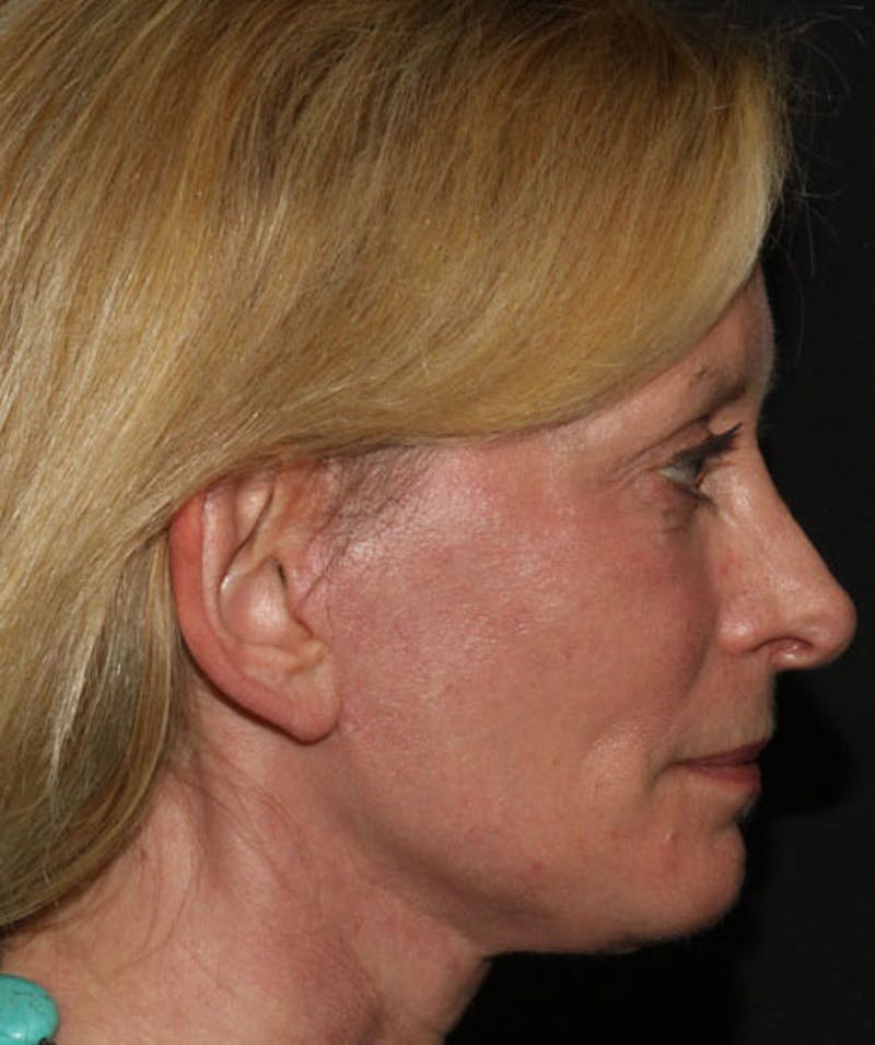 Facelift & Necklift Before & After Gallery - Patient 133024018 - Image 2