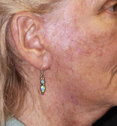 Facelift Scar Before & After Gallery - Patient 133024010 - Image 2