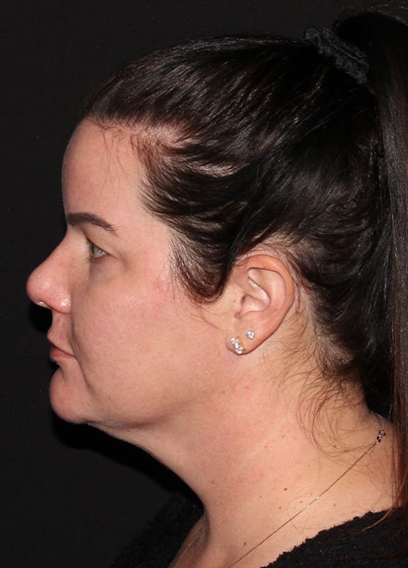Neck Liposuction Before & After Gallery - Patient 133024013 - Image 4