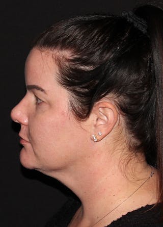 Neck Liposuction Before & After Gallery - Patient 133024013 - Image 4