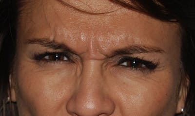 BOTOX Before & After Gallery - Patient 133024019 - Image 1