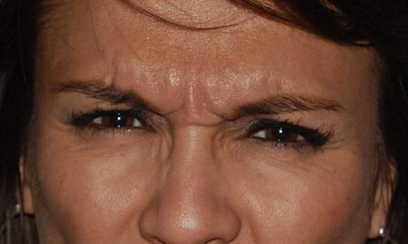 BOTOX Before & After Gallery - Patient 133024019 - Image 1