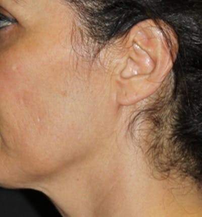 Facelift Scar Before & After Gallery - Patient 133024012 - Image 1