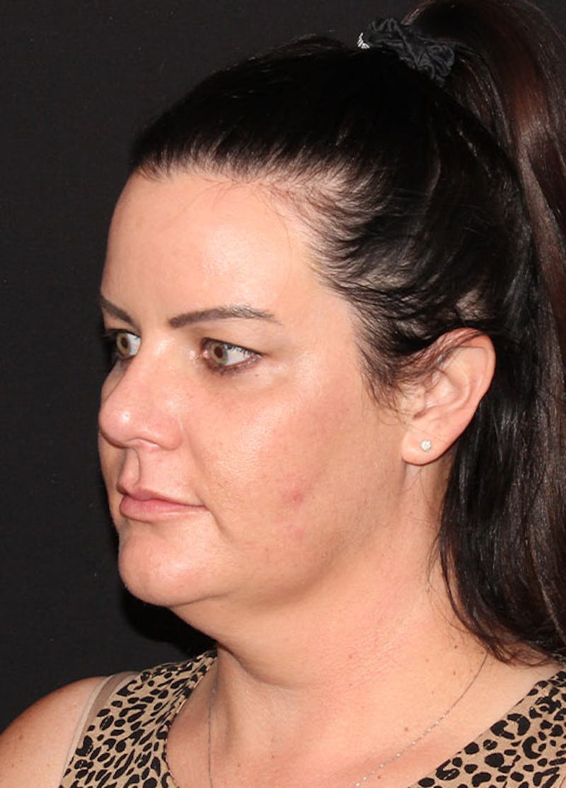 Neck Liposuction Before & After Gallery - Patient 133024013 - Image 5