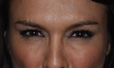 BOTOX Before & After Gallery - Patient 133024019 - Image 2