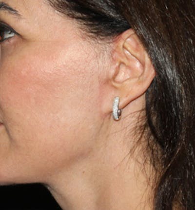 Facelift Scar Before & After Gallery - Patient 133024012 - Image 2