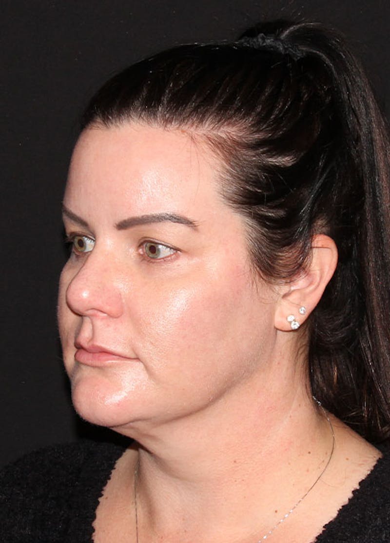 Neck Liposuction Before & After Gallery - Patient 133024013 - Image 6