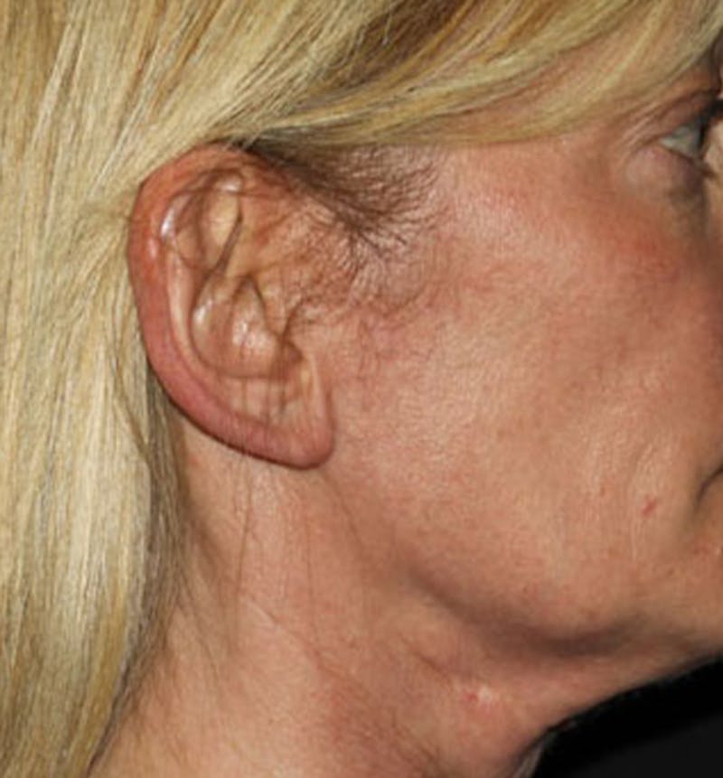Facelift Scar Before & After Gallery - Patient 133024020 - Image 1
