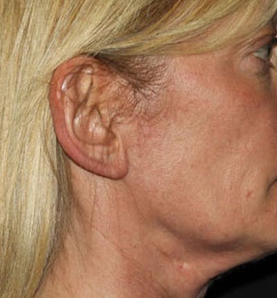 Facelift Scar Before & After Gallery - Patient 133024020 - Image 1