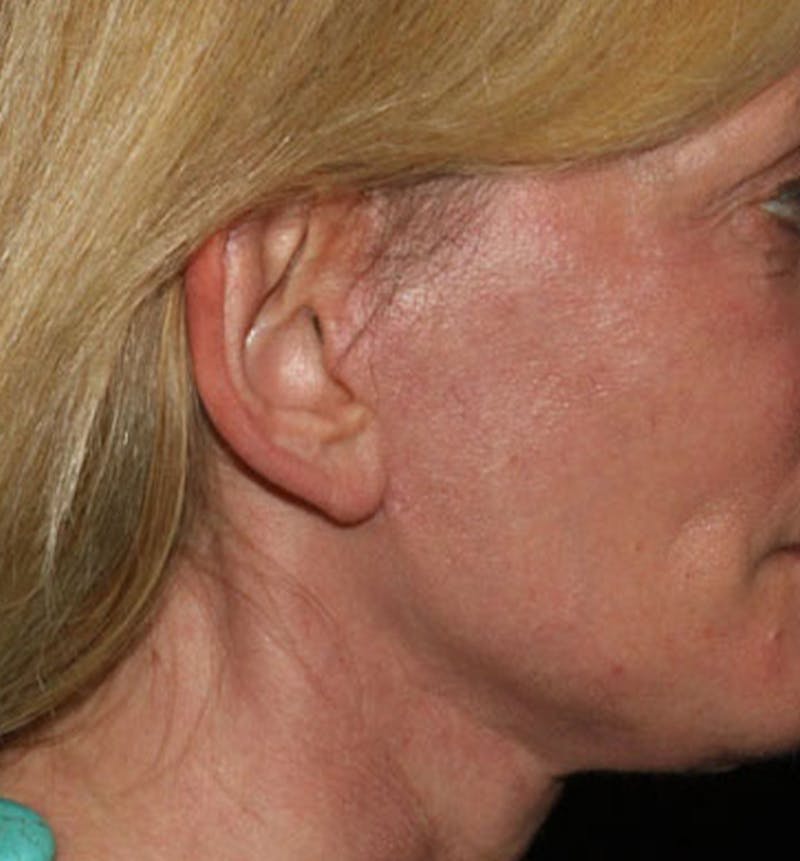 Facelift Scar Before & After Gallery - Patient 133024020 - Image 2