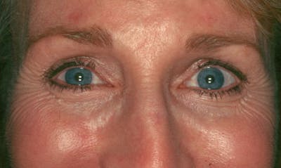 BOTOX Before & After Gallery - Patient 133024023 - Image 1