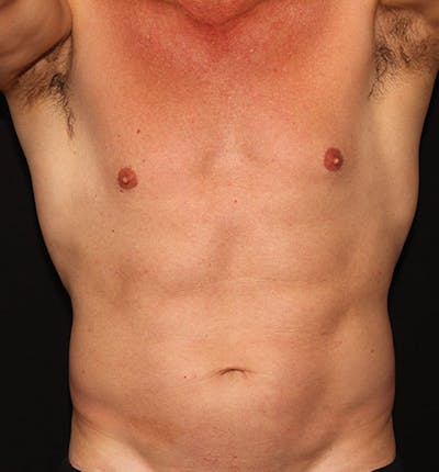 truSculpt flex Before & After Gallery - Patient 133024026 - Image 1