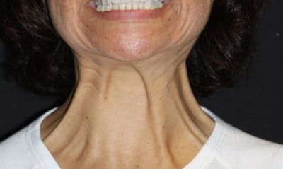 BOTOX Before & After Gallery - Patient 133024029 - Image 1