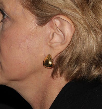 Facelift Scar Before & After Gallery - Patient 133024028 - Image 2