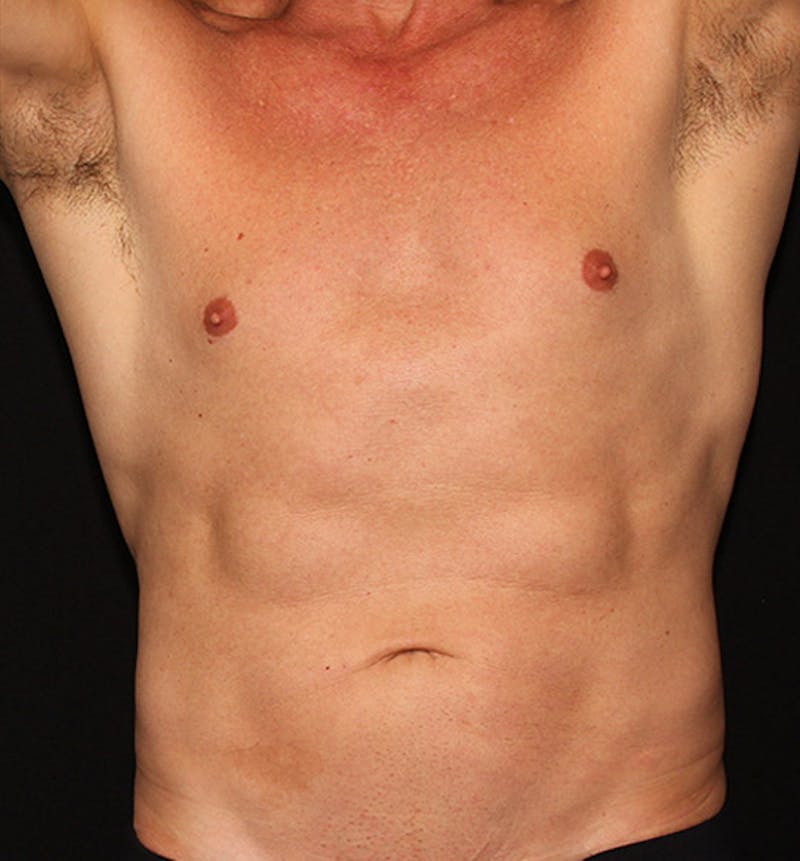 truSculpt flex Before & After Gallery - Patient 133024026 - Image 2