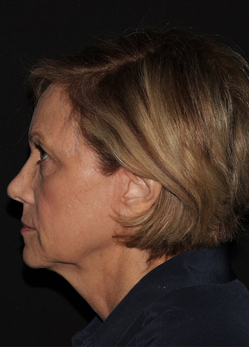 Facelift & Necklift Before & After Gallery - Patient 133024040 - Image 3