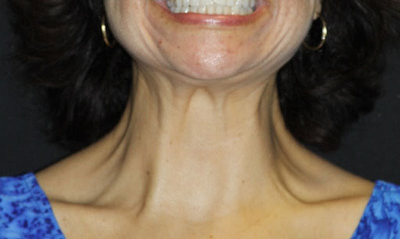 BOTOX Before & After Gallery - Patient 133024029 - Image 2