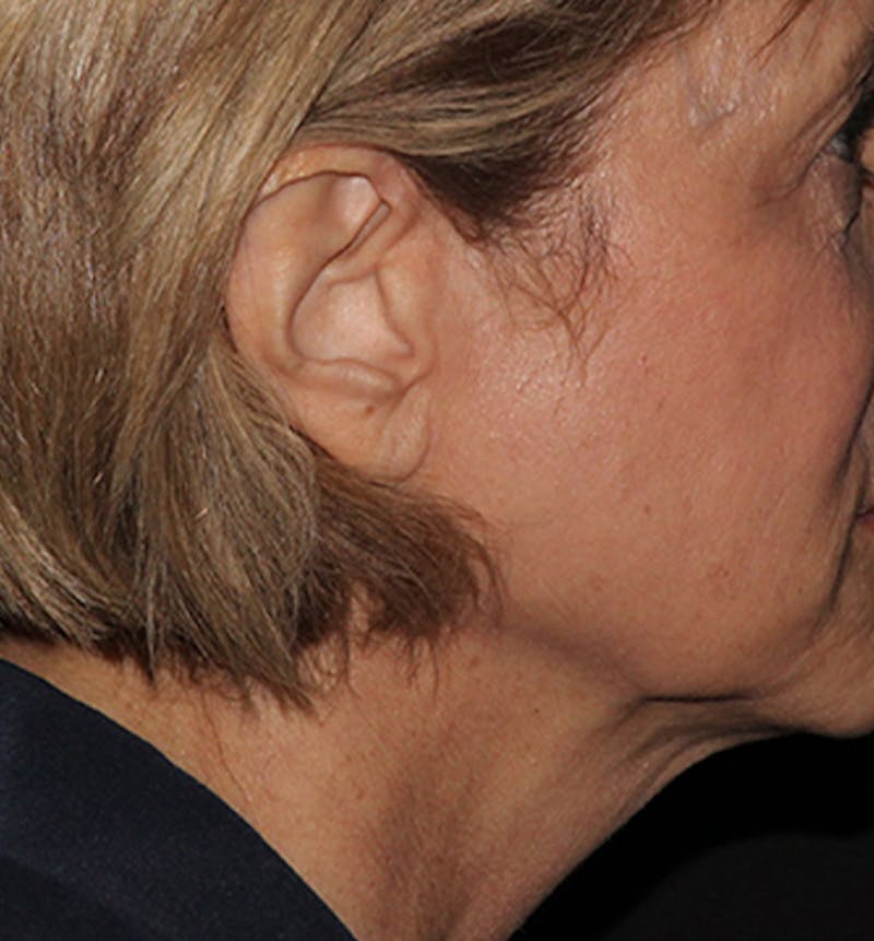 Facelift Scar Before & After Gallery - Patient 133024028 - Image 3