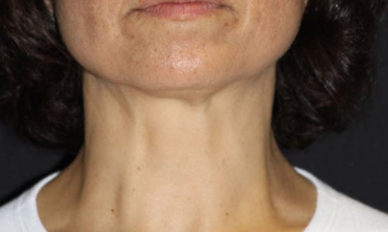 BOTOX Before & After Gallery - Patient 133024029 - Image 3