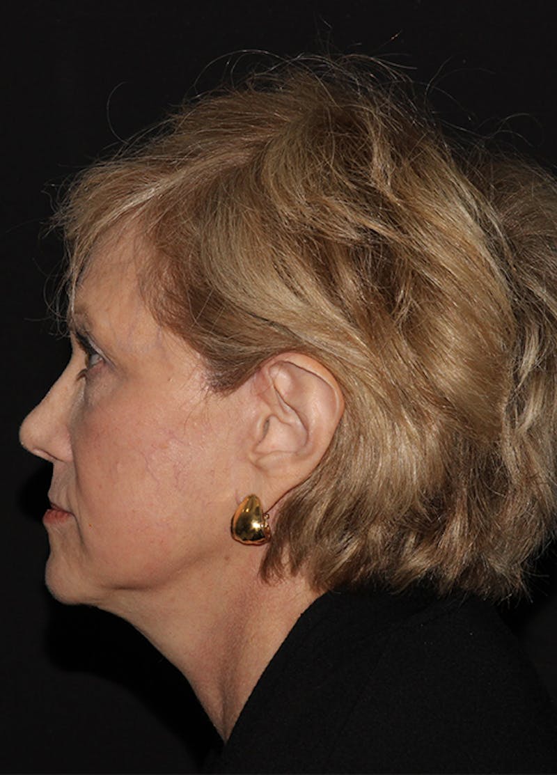 Facelift & Necklift Before & After Gallery - Patient 133024040 - Image 4