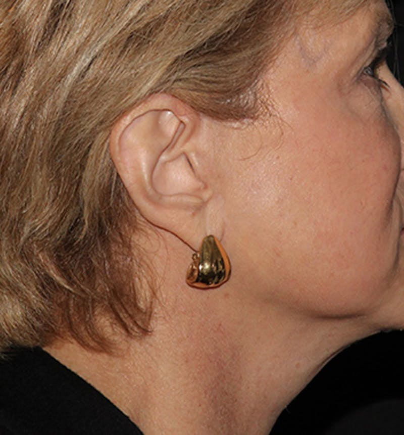 Facelift Scar Before & After Gallery - Patient 133024028 - Image 4