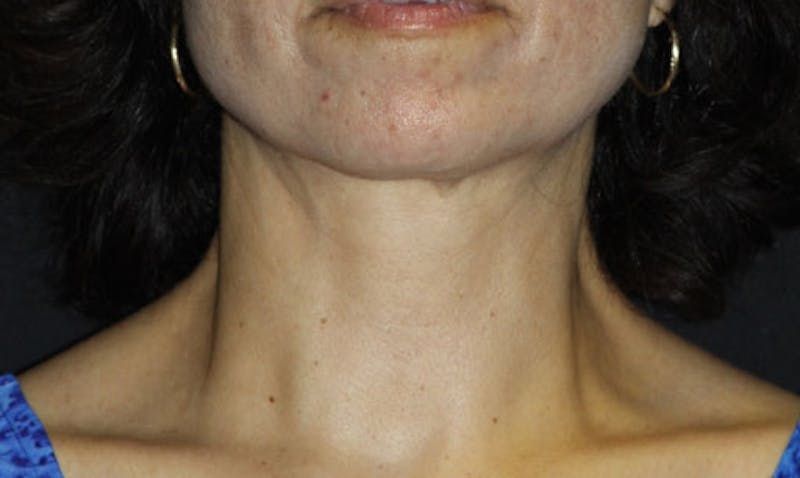 BOTOX Before & After Gallery - Patient 133024029 - Image 4