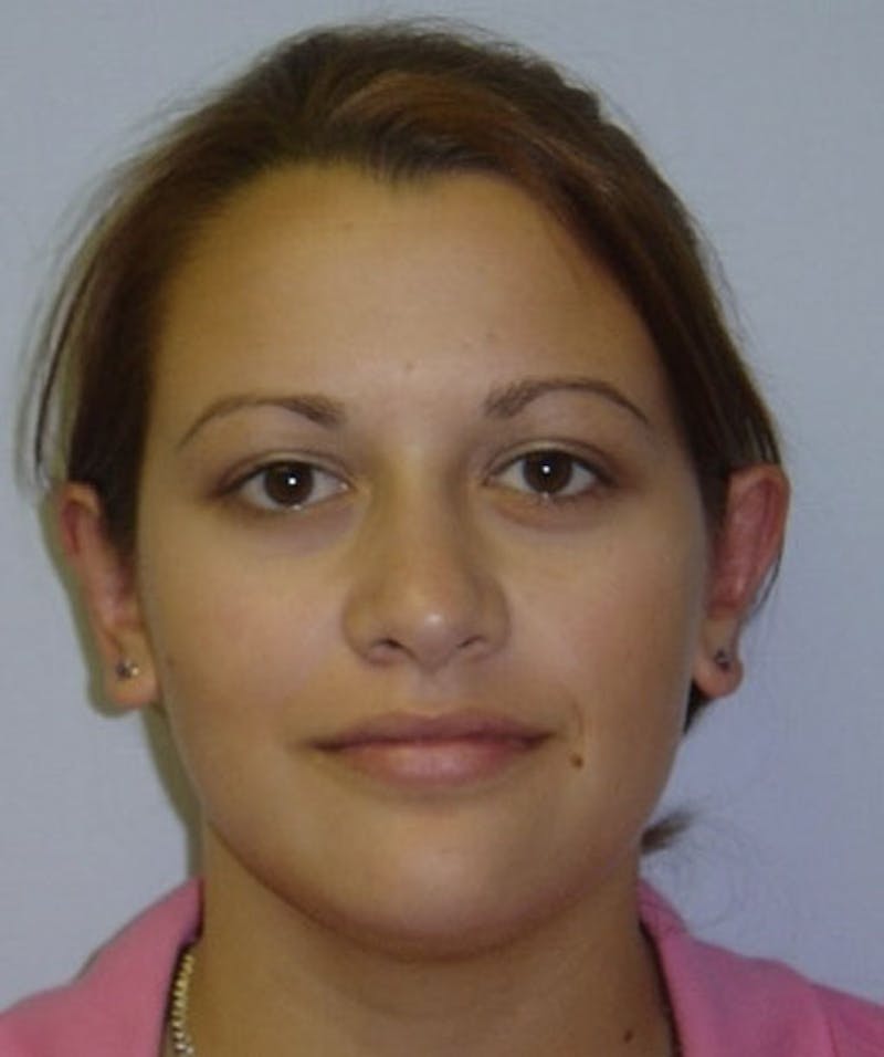 Otoplasty Before & After Gallery - Patient 133024030 - Image 2