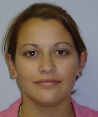 Otoplasty Before & After Gallery - Patient 133024030 - Image 2