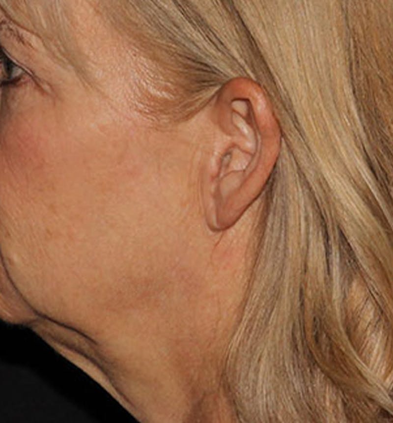 Facelift Scar Before & After Gallery - Patient 133024036 - Image 1