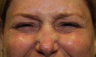 BOTOX Before & After Gallery - Patient 133024034 - Image 1