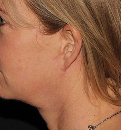 Facelift Scar Before & After Gallery - Patient 133024036 - Image 2