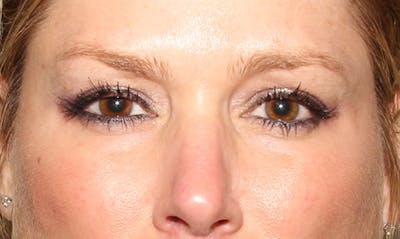 BOTOX Before & After Gallery - Patient 133024034 - Image 2