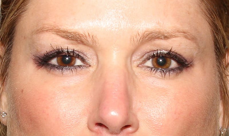 BOTOX Before & After Gallery - Patient 133024034 - Image 2