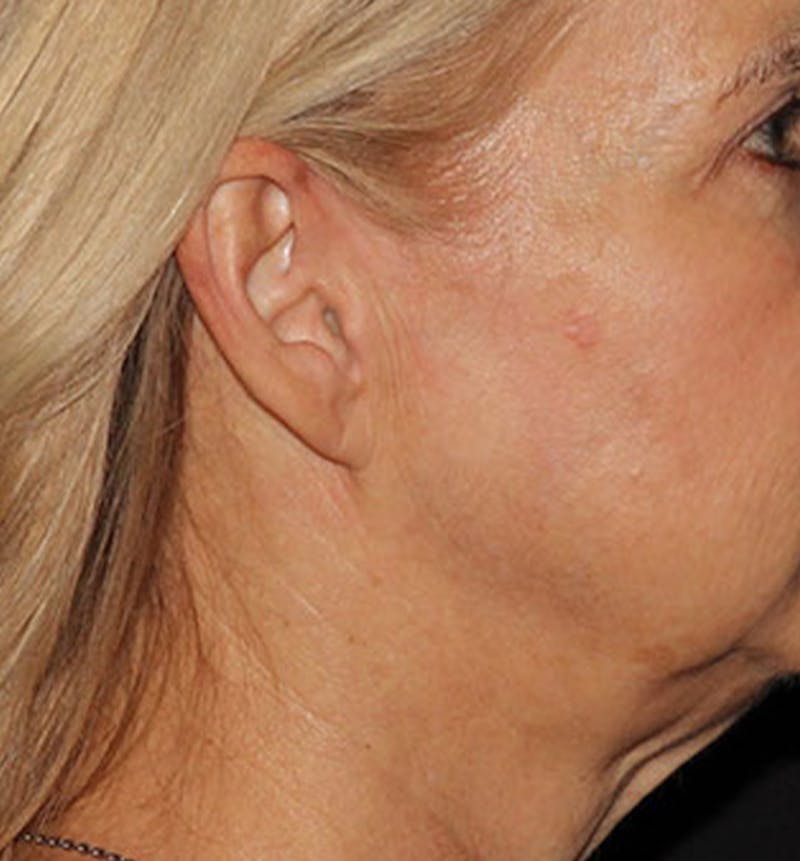 Facelift Scar Before & After Gallery - Patient 133024036 - Image 3