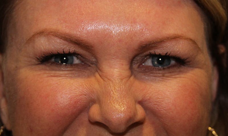 BOTOX Before & After Gallery - Patient 133024037 - Image 1