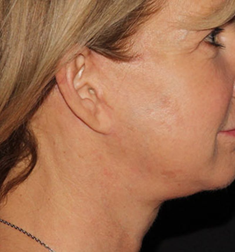 Facelift Scar Before & After Gallery - Patient 133024036 - Image 4