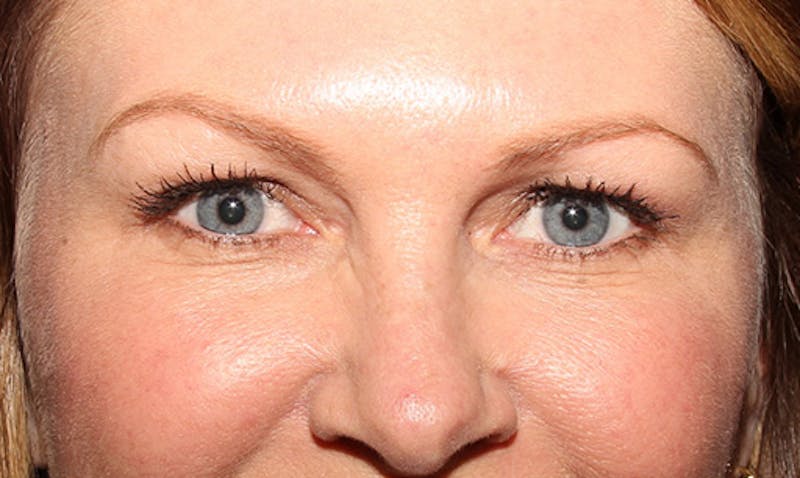 BOTOX Before & After Gallery - Patient 133024037 - Image 2