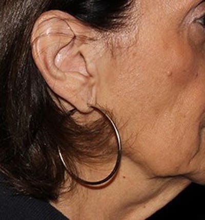 Facelift Scar Before & After Gallery - Patient 133024039 - Image 1