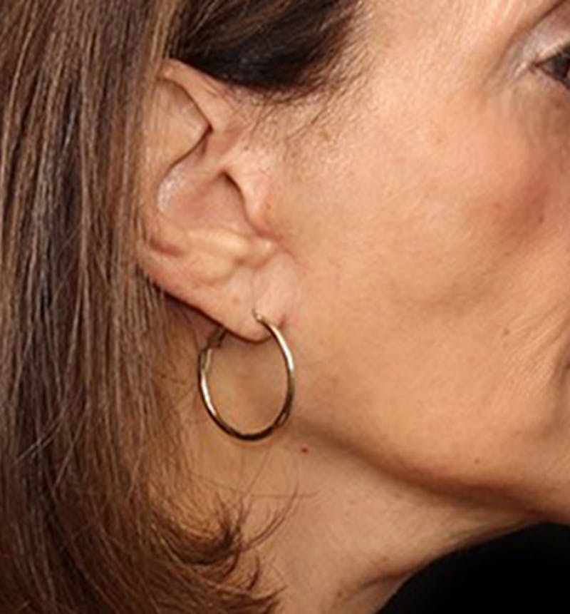 Facelift Scar Before & After Gallery - Patient 133024039 - Image 2