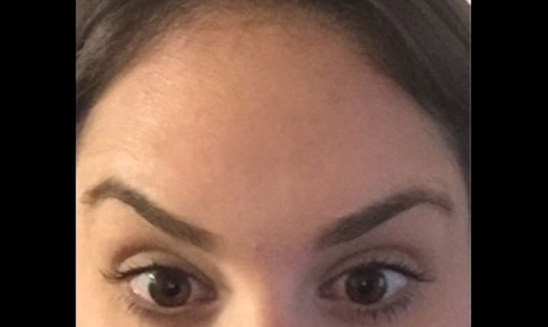 BOTOX Before & After Gallery - Patient 133024038 - Image 2