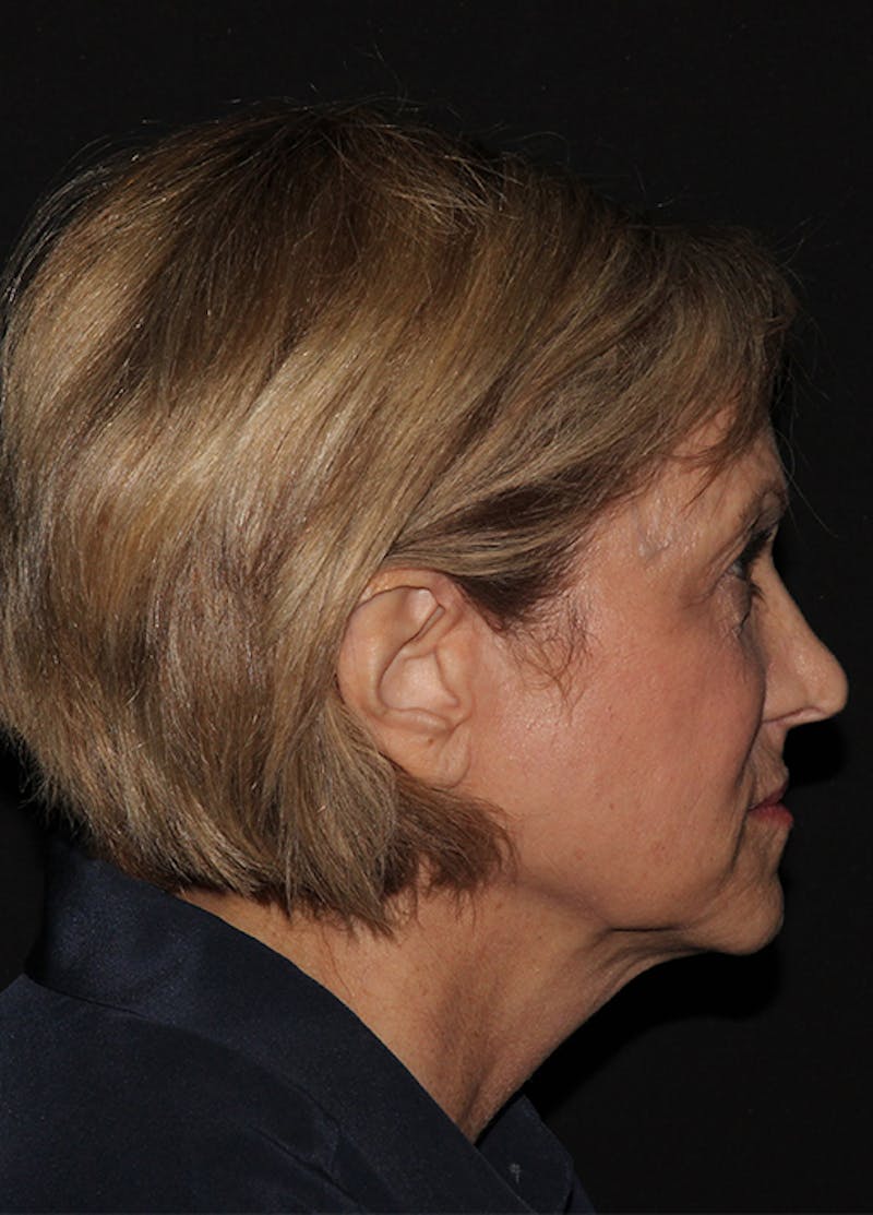 Facelift & Necklift Before & After Gallery - Patient 133024040 - Image 9