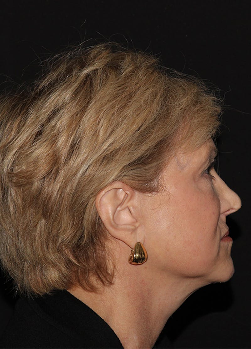 Facelift & Necklift Before & After Gallery - Patient 133024040 - Image 10